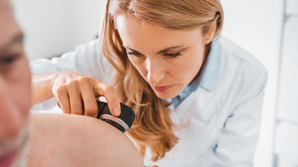 melanoma